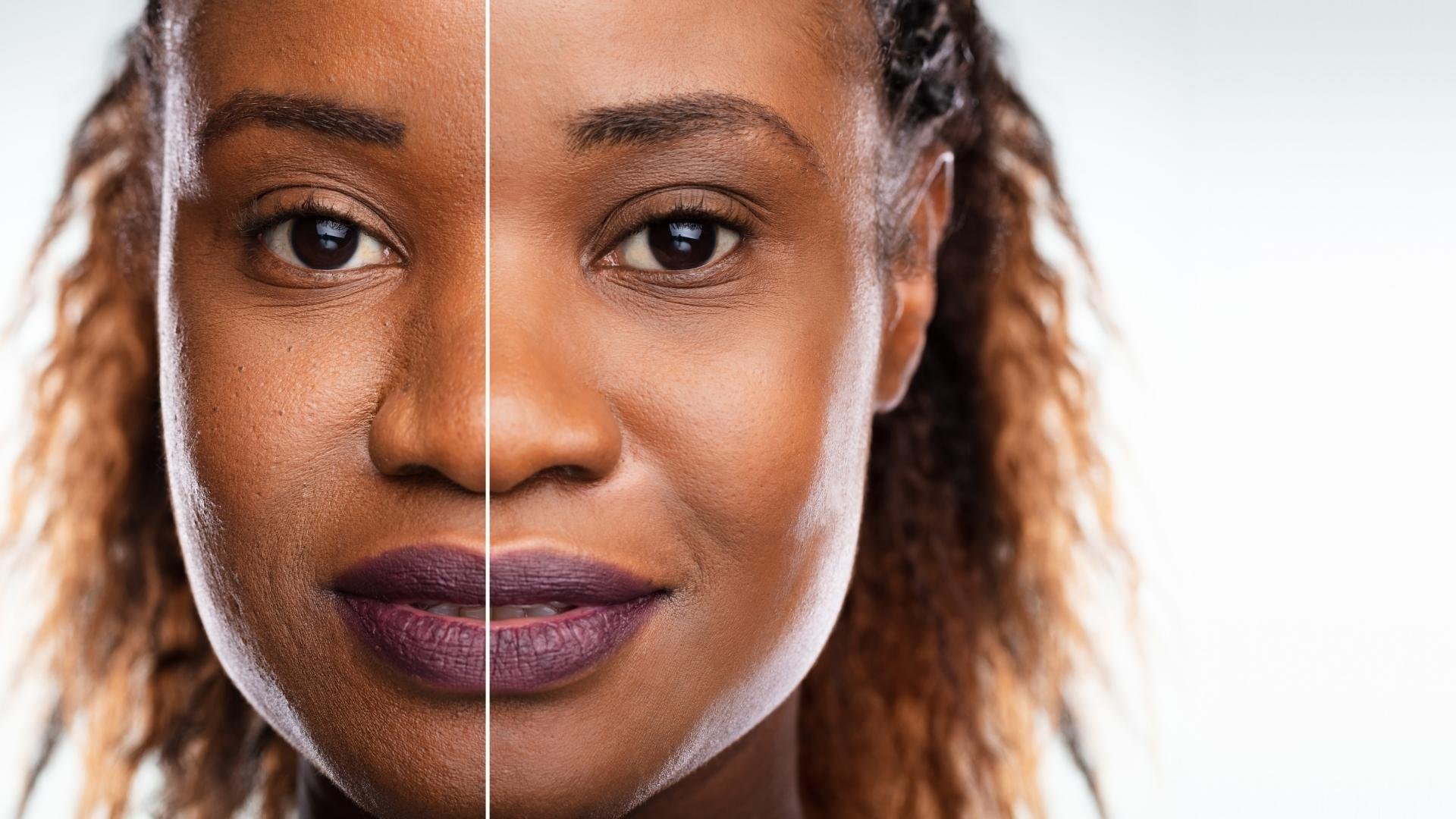 results-microdermabrasion